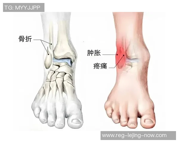 足球运动中的脚踝骨折风险及预防措施探讨